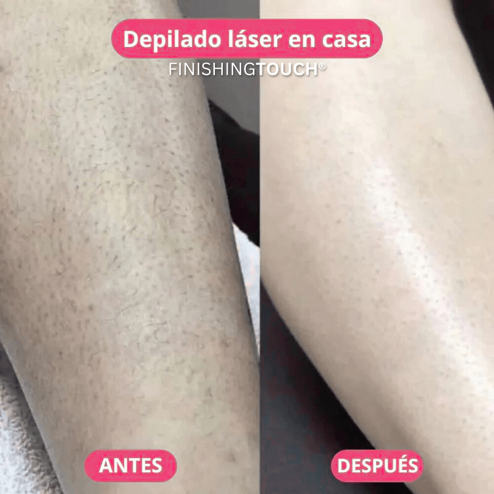 DEPILADORA LÁSER CORPORAL